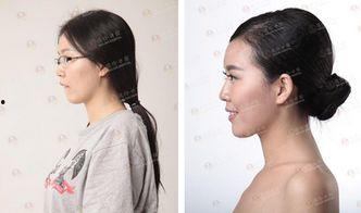 正畸吃瓜,揭秘牙齿矫正背后的那些吃瓜故事